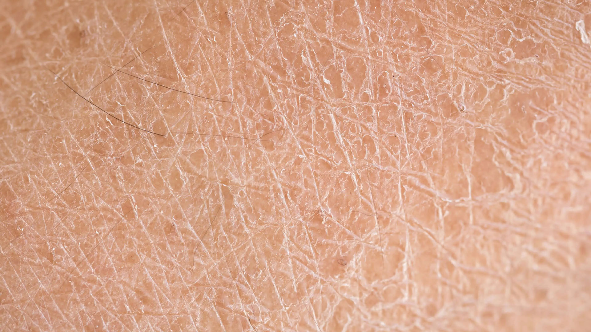 خشکی پوست؛ چرا پوست شما حتی پس از مرطوب کردن احساس خشکی می‌کند؟
