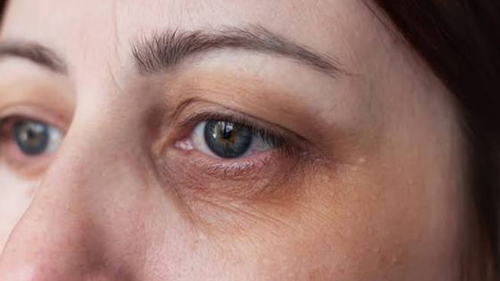 علت تیرگی دور چشم چیست؟